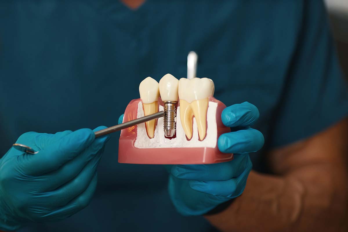 Impianti Dentali