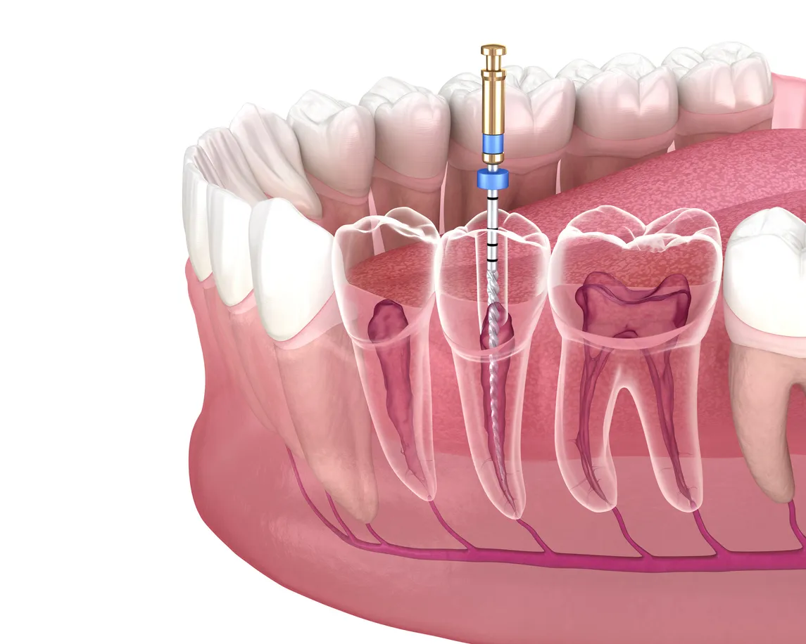 Devitalizzazione dente Devitalizzazione dente