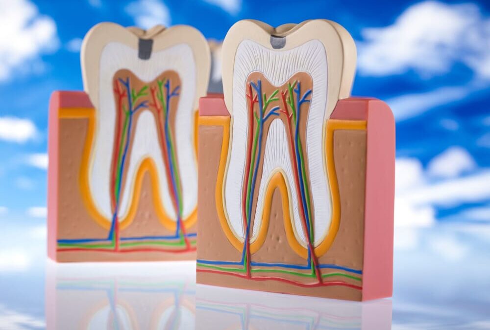 Dente devitalizzato rotto